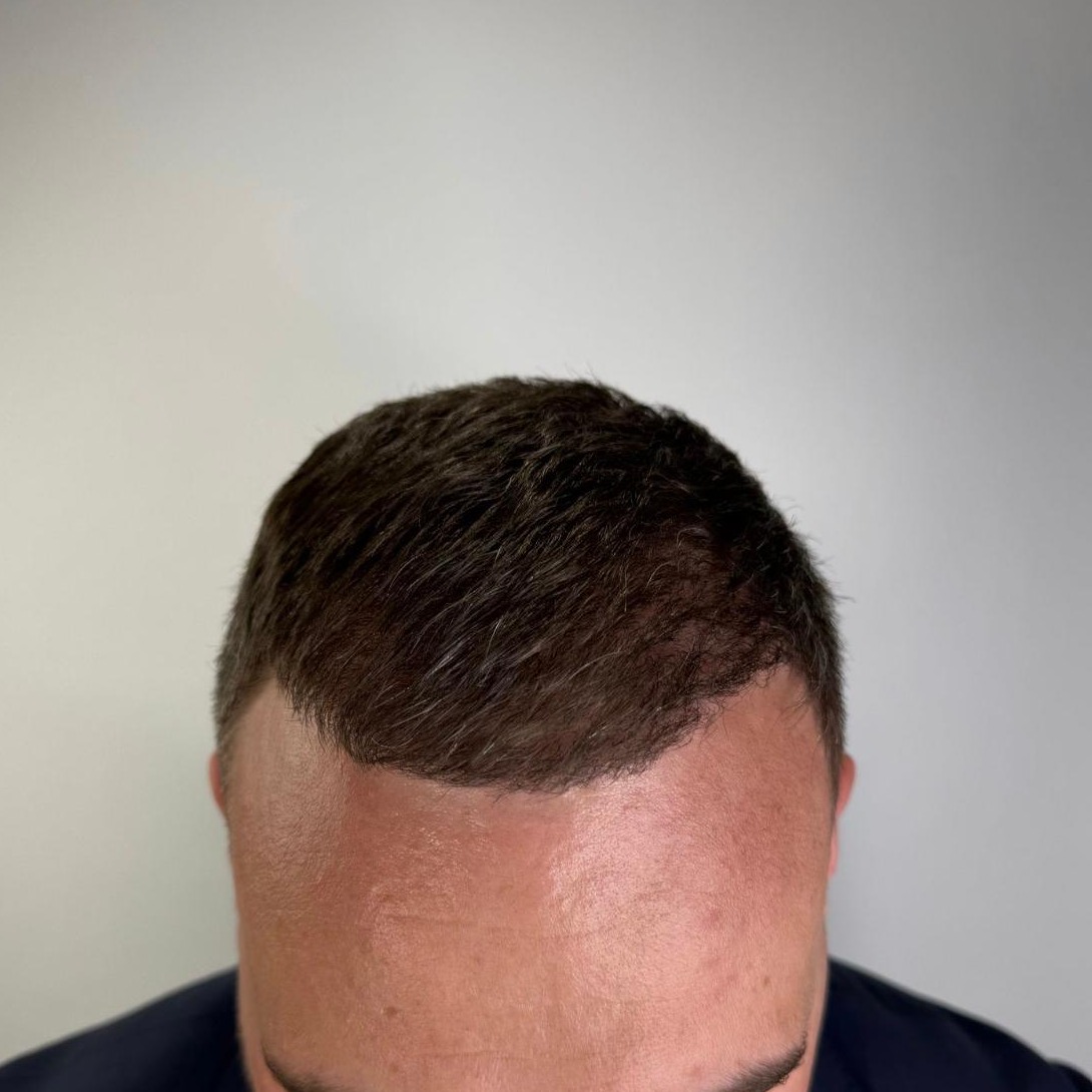 FUE Hair Transplant after treatment