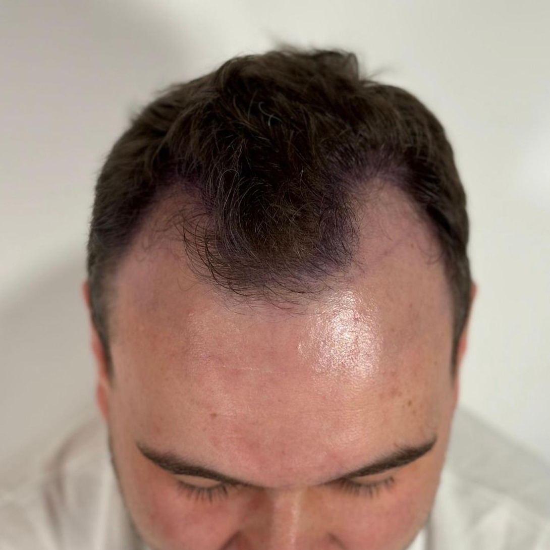 FUE Hair Transplant before treatment