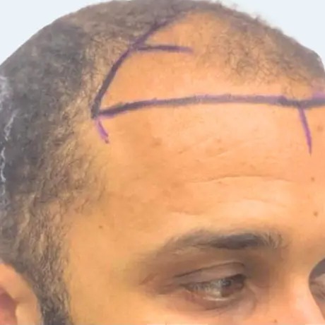 Hairline Restoration before treatment