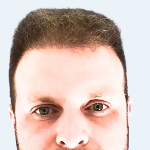 Crown Restoration after treatment