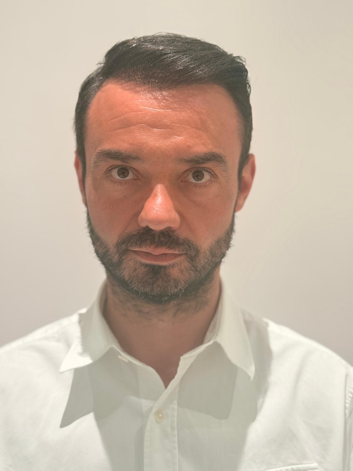 Hair restoration after treatment, frontal view