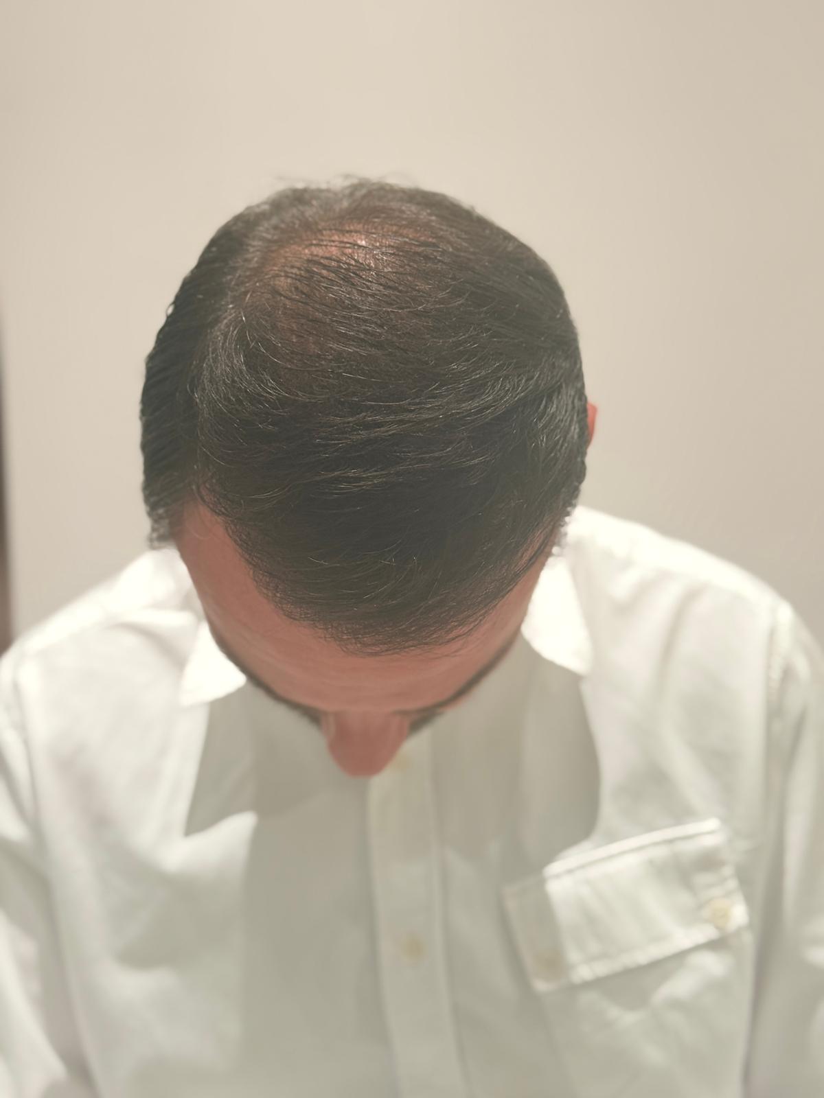 Hair restoration result after treatment, top view