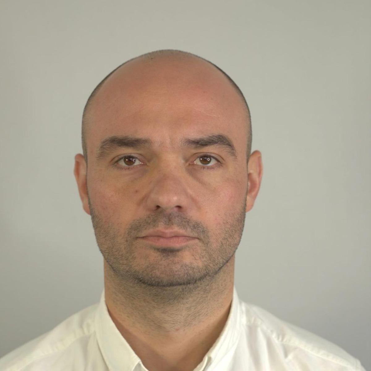 Hair restoration before treatment, frontal view