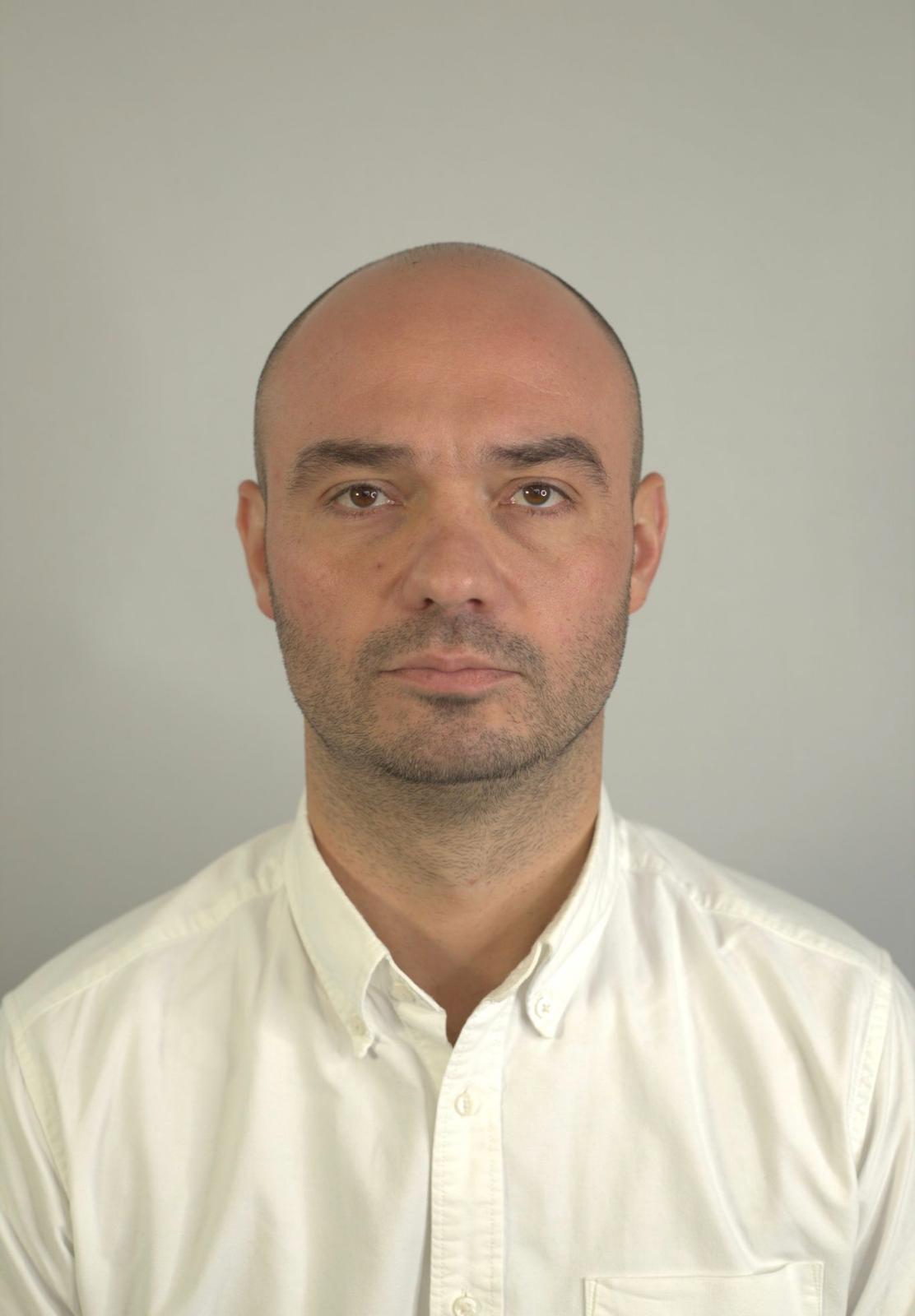 Hair restoration before treatment, frontal view
