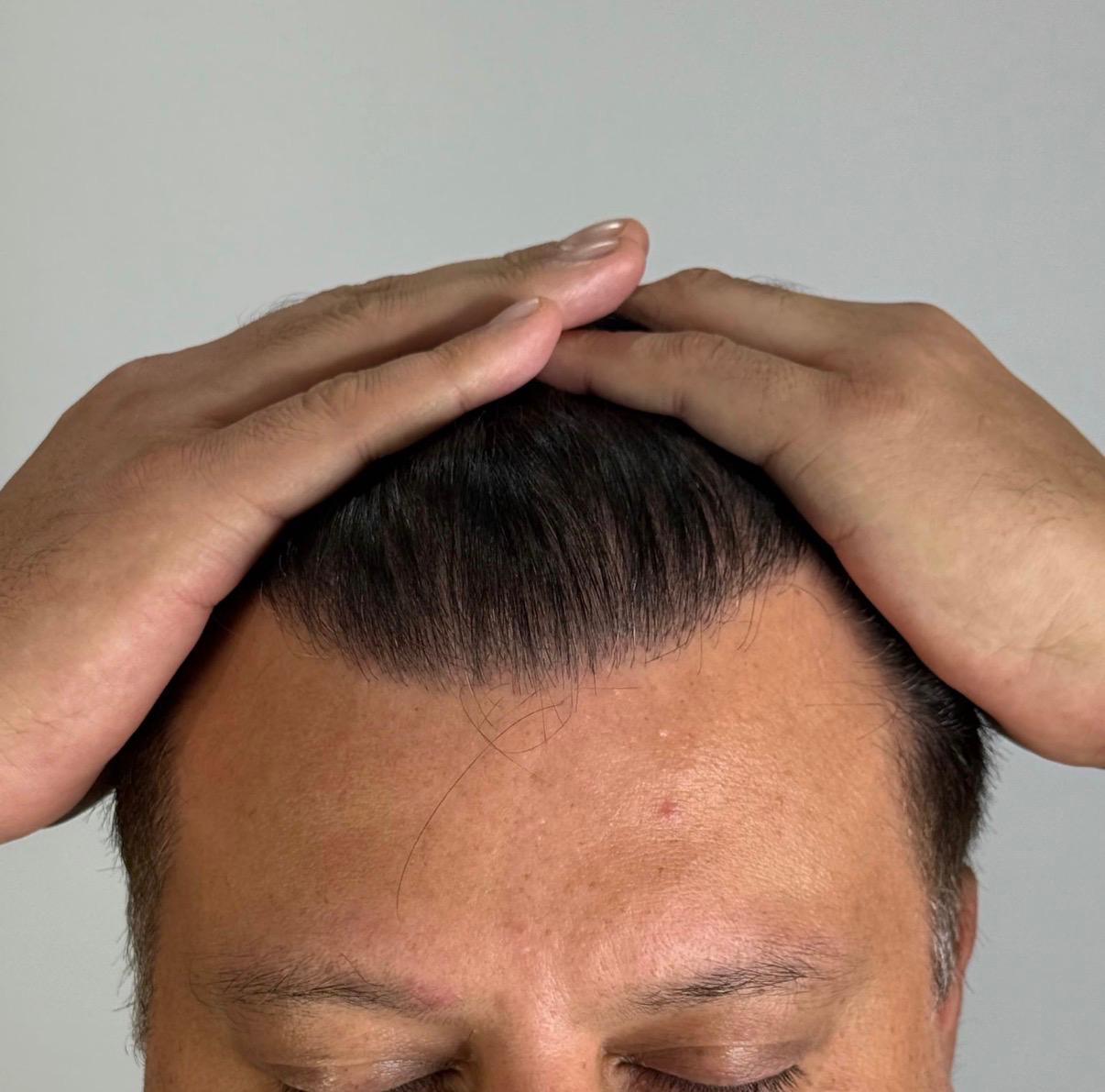 Hairline restoration after treatment, frontal view