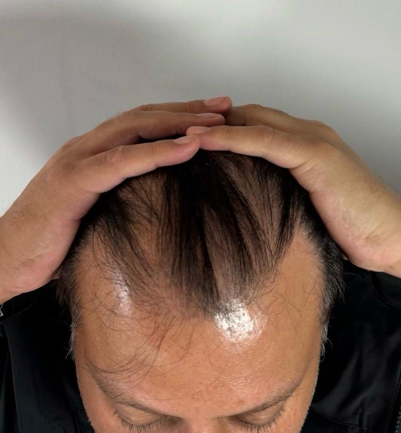 Hairline restoration before treatment, frontal view