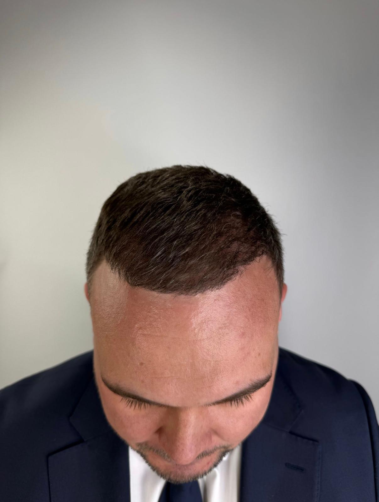 Hairline restoration after treatment, frontal view