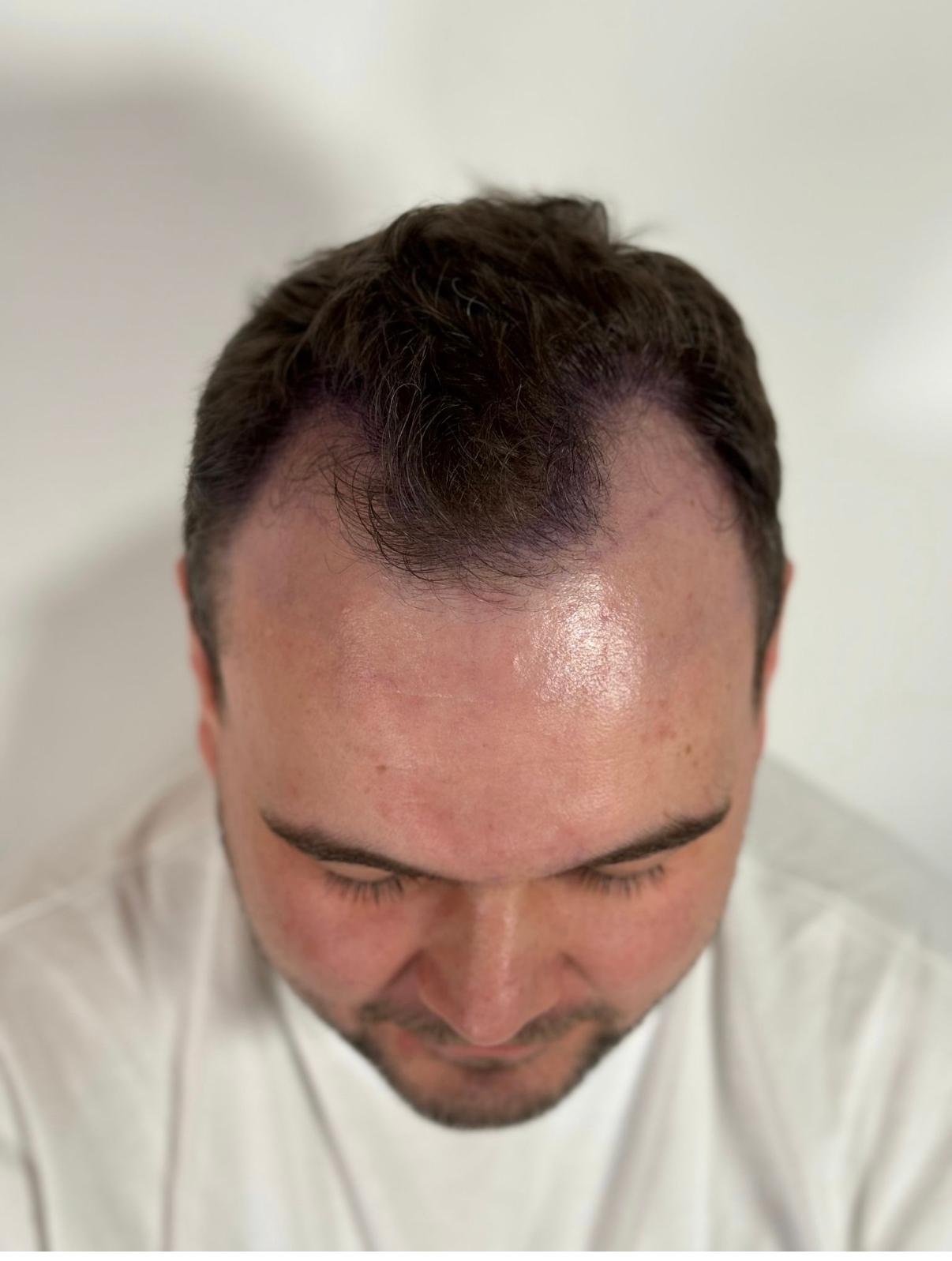 Hairline restoration before treatment, frontal view