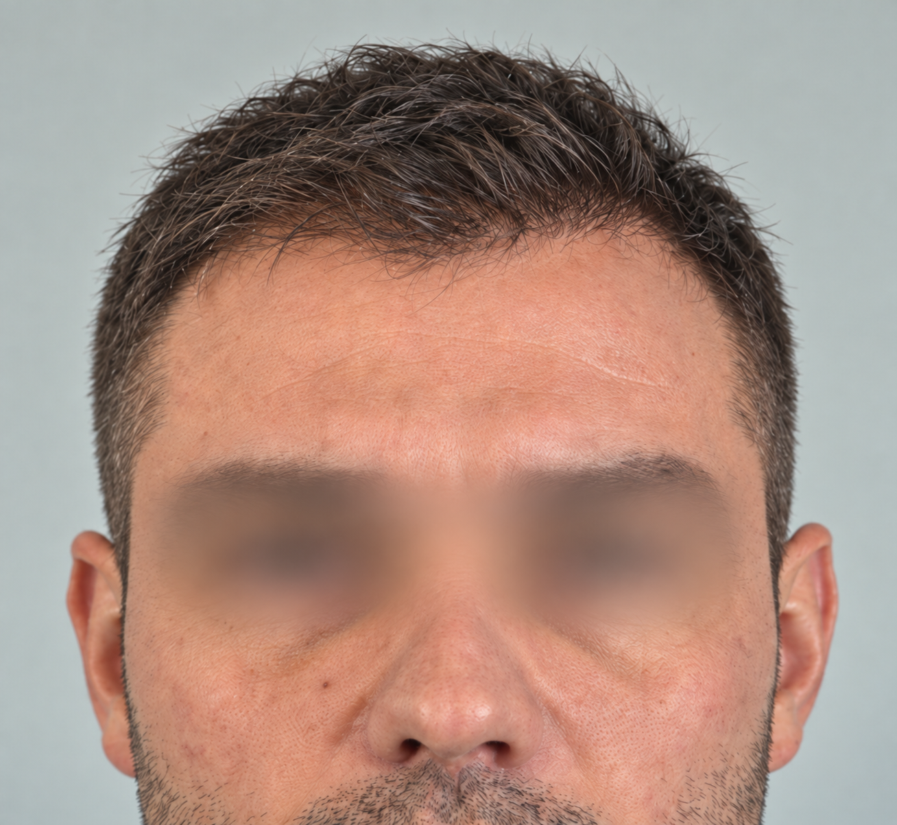 Patient after hair restoration treatment, frontal view