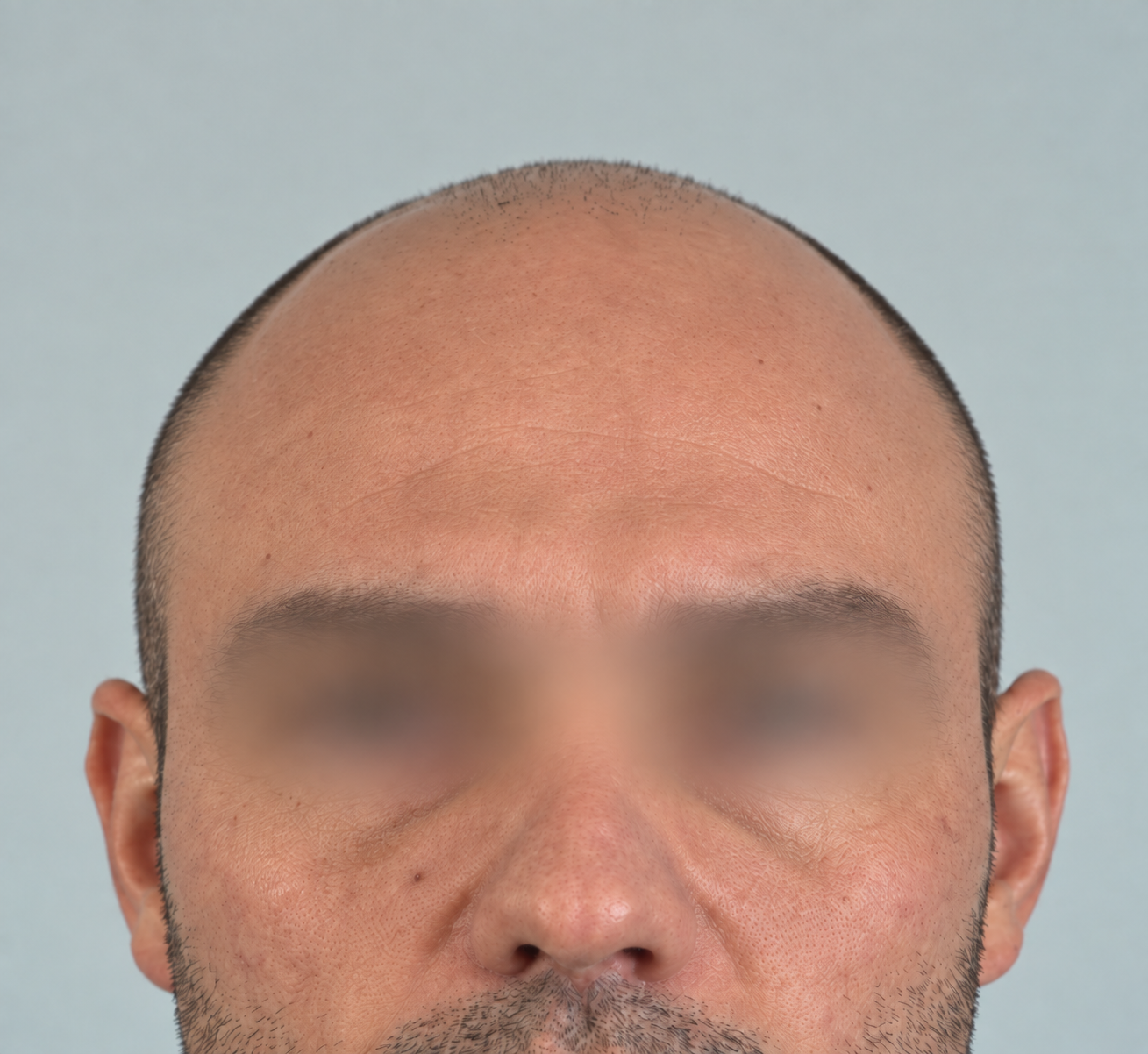 Patient before hair restoration treatment, frontal view