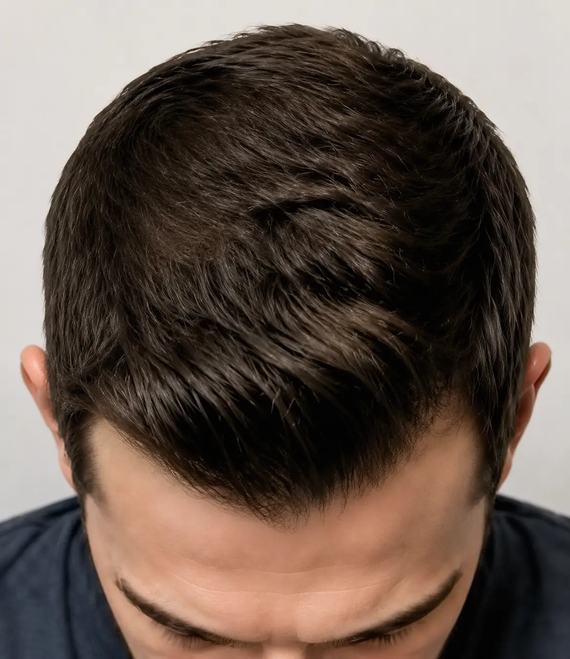 Patient Result 01 after hair restoration treatment, top view