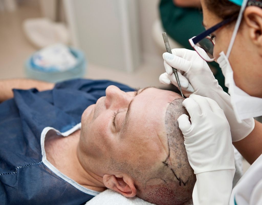 Mens Hair Transplant London