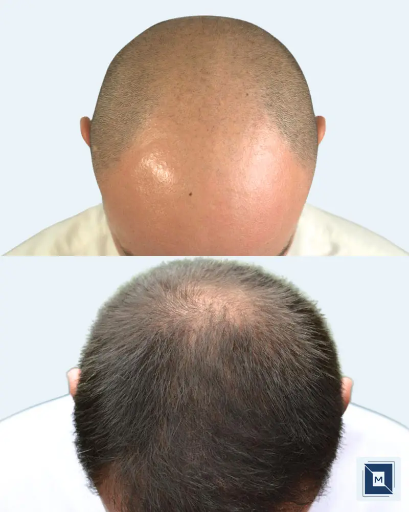 Minimalist Before After Salon & Makeup Instagram Post - Before &