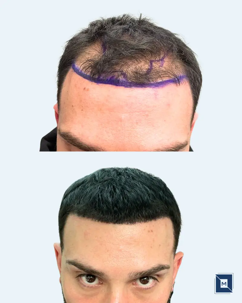 Minimalist Before After Salon & Makeup Instagram Post - Before &