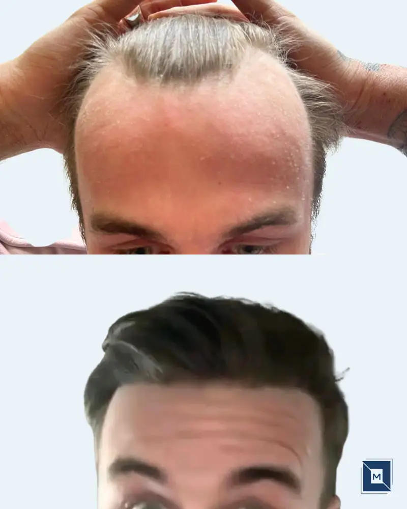 Minimalist Before After Salon & Makeup Instagram Post - Before &
