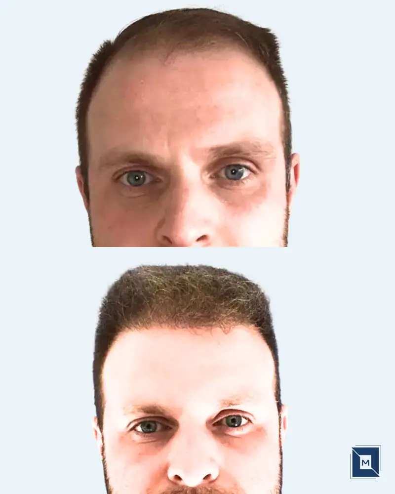 Minimalist Before After Salon & Makeup Instagram Post - Before &