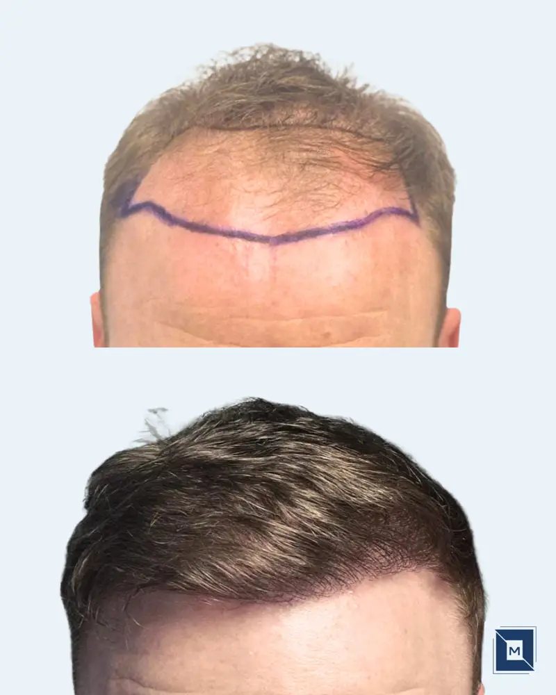 Minimalist Before After Salon & Makeup Instagram Post - Before &